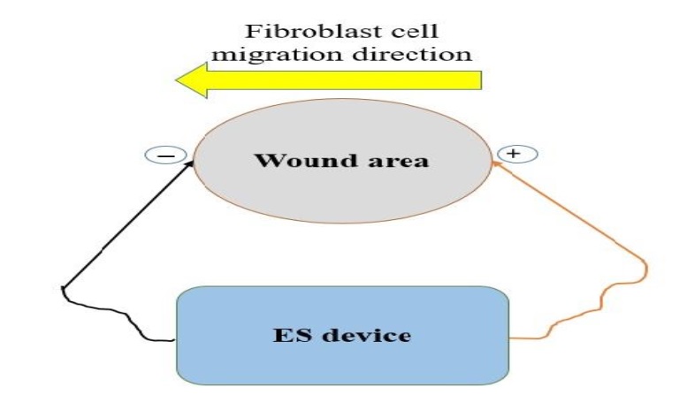 The electrode placement of the ES deive in the wound healing procedure