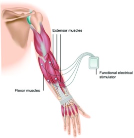 MOTIMOVE functional electrical stimulation system 