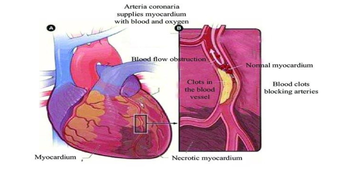 The figure illustrated the myocardial infarction of the human heart 